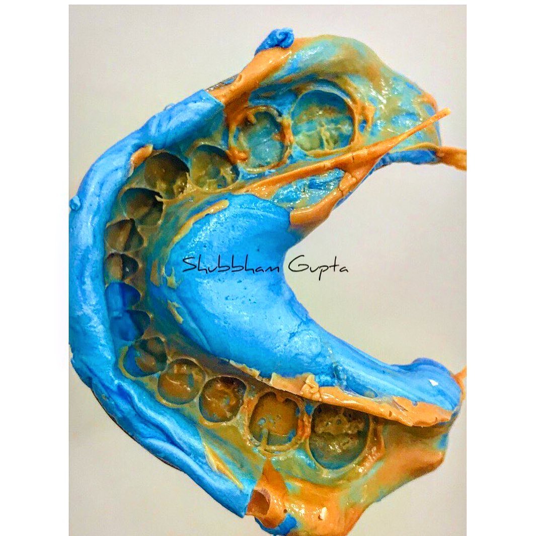 image-denture1