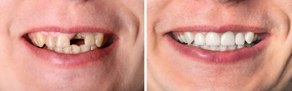 Crowns And Bridge | R K Dental Clinic